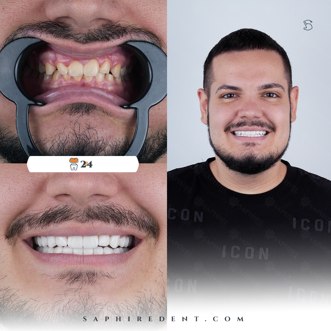 Dental Crowns